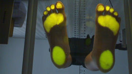 Podológ študuje mapu chodidla. Je to dôležité? 