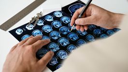 Roztrúsená skleróza: O čo ide?