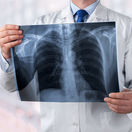 doktor, snímka, pľúca, röntgen, RTG