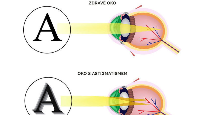 astigmatismus, zrak