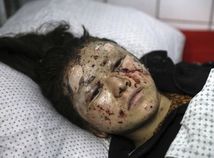 Afganistan / Kábul / Dieťa / Zranenie /