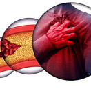 cholesterol, upchávanie ciev, infarkt