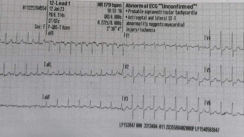 Abnormálne EKG pri tachykardii u 63-ročnej...