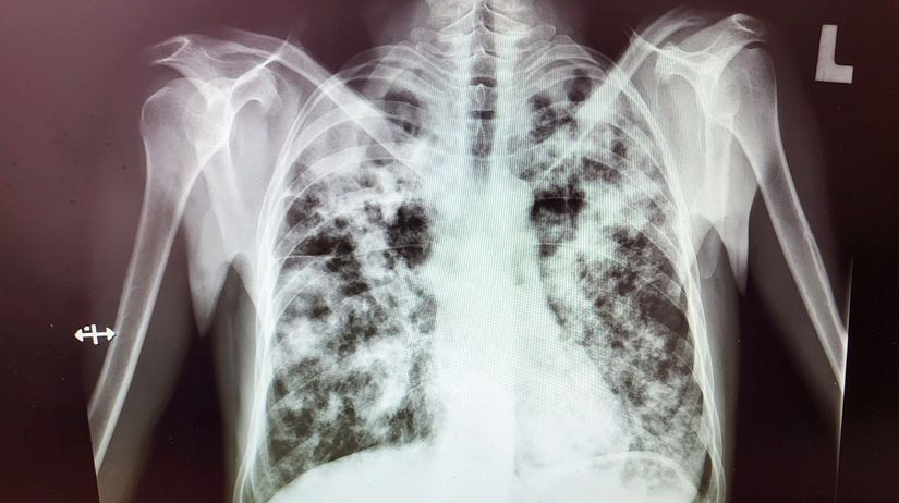 tbc, TBC, pľúca, tuberkulóza