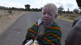 albín, albíni, Afrika