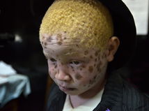 albín, albíni, albinizmus, Afrika, Malawi