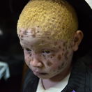 albinos, albinos, albinism, Africa, Malawi
