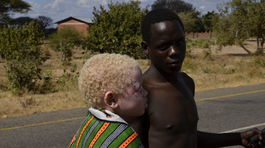 albín, albíni, albinizmus