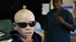albín, albíni, albinizmus, Malawi