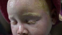 albín, albíni, Malawi, albinizmus