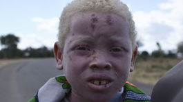 albín, albinizmus, Afrika