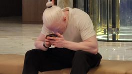 albin, albinizmus, albíni