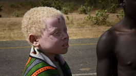 albín, albinizmus