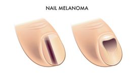 dva znaky melanomu pod nechtom, melanóm, necht, podnechtový melanóm