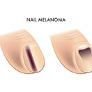 dva znaky melanomu pod nechtom, melanóm, necht, podnechtový melanóm