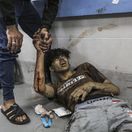 Palestínčania / Ranení / al-Shifa / Gaza /