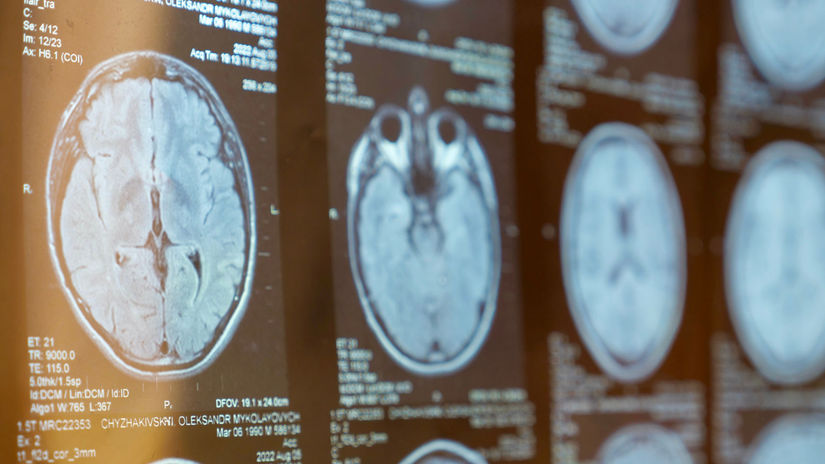 mozog, skleróza, neurológ, skan, scan