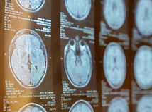 Vedci našli konkrétny rozdiel v mozgu ľudí...