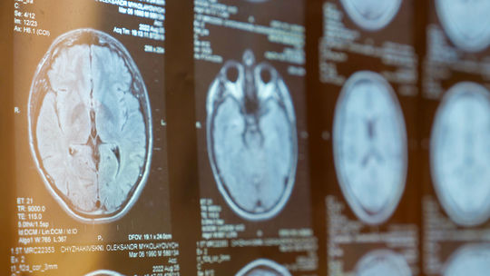 Vedci našli konkrétny rozdiel v mozgu ľudí s autizmom. Môže to zmeniť prístup k diagnóze aj liečbe