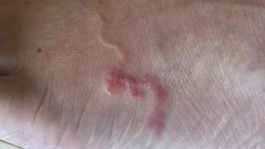 Larva cutanea: Pohybuje sa pomaly (zvyčajne...