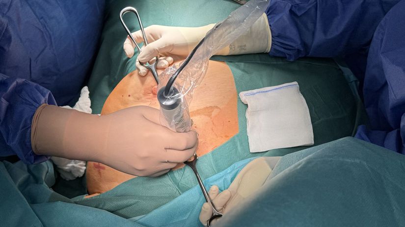 rakovina prsníka, operácia, zákrok, chirurg,...