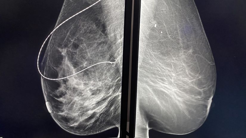 Drôtik (naľavo) verzus magnetické zrno pod rtg.