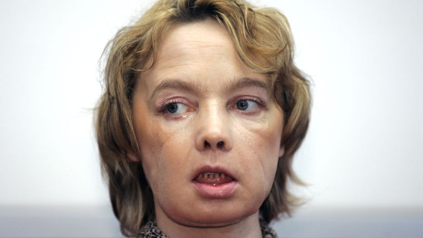 Dňa 28. mája 2005 sa Isabelle Dinoire prebudila...