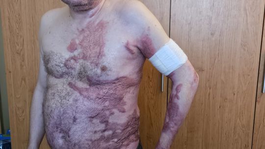 Pri údržbe vysokého napätia dostal zásah, prežil. Druhý šok ho čakal po návrate z nemocnice