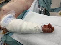 pacient nemocnica amputácia brno chirurgia