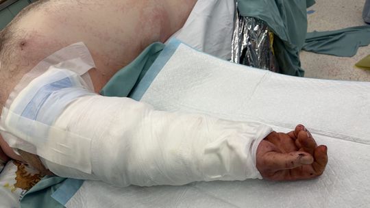 Išlo o minúty: Českí lekári pri unikátnom zákroku prišili pacientovi odtrhnutú ruku