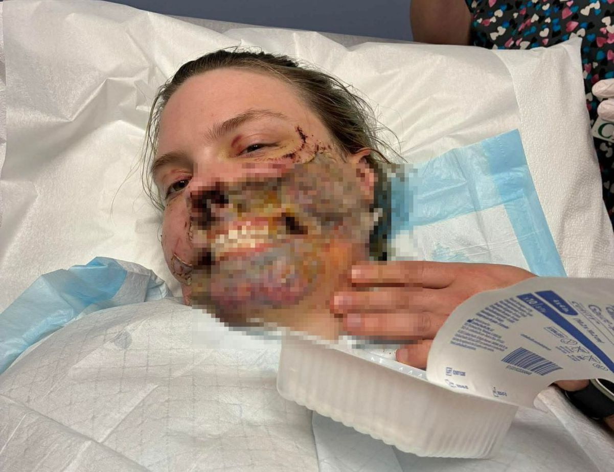 Karma Davis after surgery.
